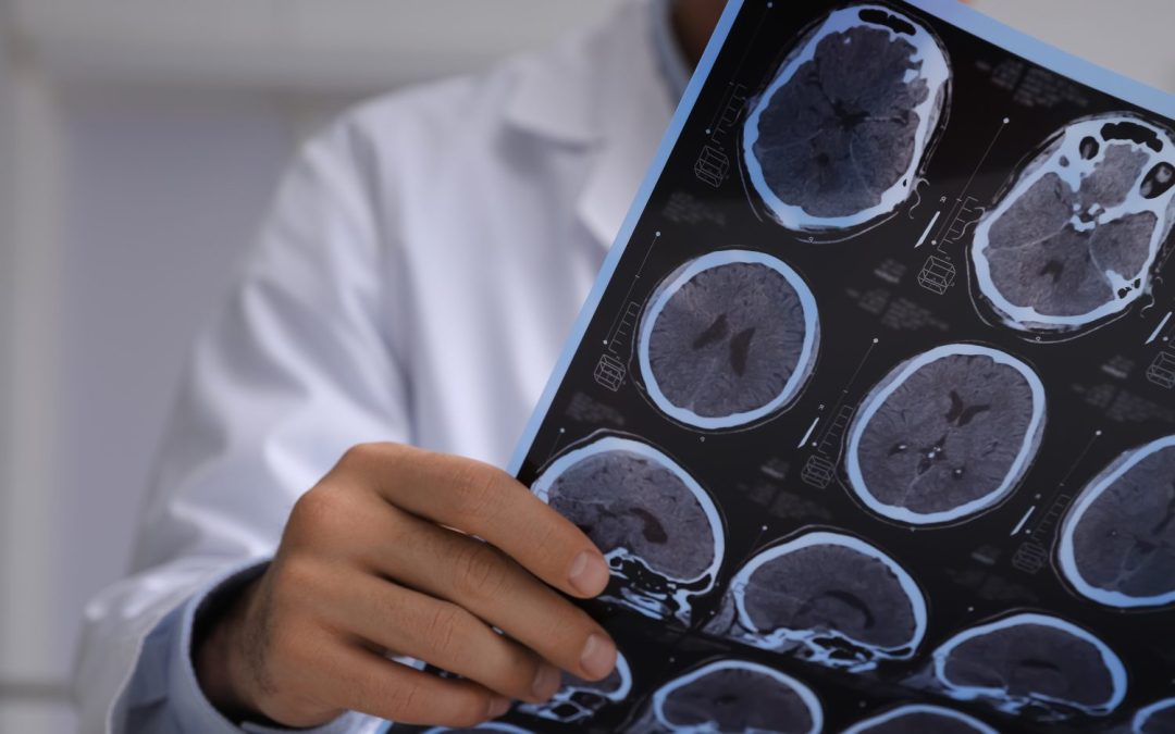Mental Health Disorders Common Following Mild Head Injury